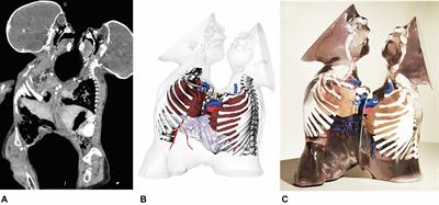 Advanced 3D “Modeling” and “Printing” for the Surgical Planning of a Successful Case of Thoraco-Omphalopagus Conjoined Twins Separation